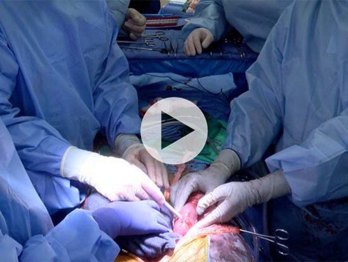 First clinical-grade transplant of gene-edited pig kidneys into brain-dead human